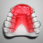 Removable Bite Plate