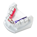 Schwartz Removable Expanders